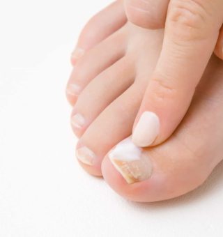 remédios para fungos na unha dos pés / unhas dos pés